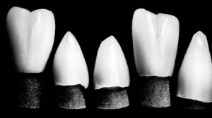 Wat is tandsteen en hoe ontstaat het